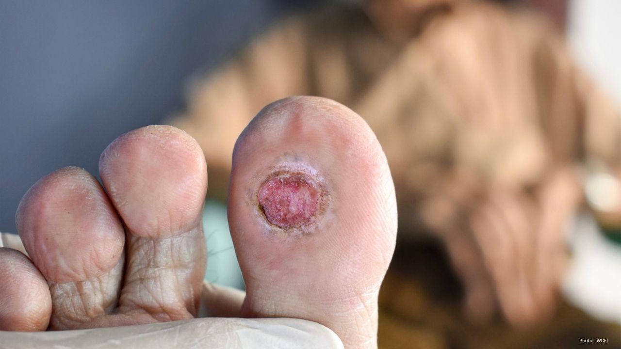 High Blood Sugar Slowly Damages Feet, Doctors Warn About Diabetic Foot Ulcers High Blood Sugar Slowly Damages Feet, Doctors Warn About Diabetic Foot Ulcers