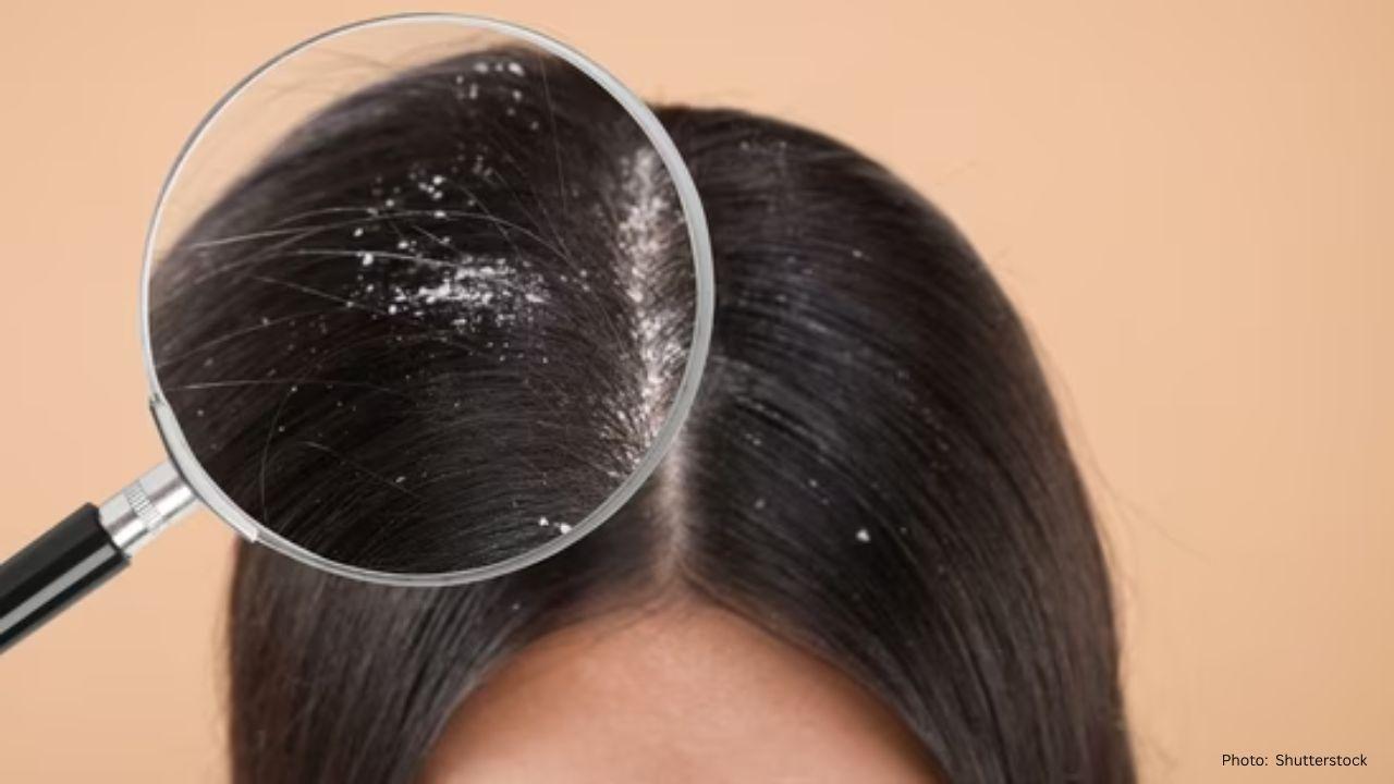 8 Effective Home Remedies for Naturally Combating Dandruff