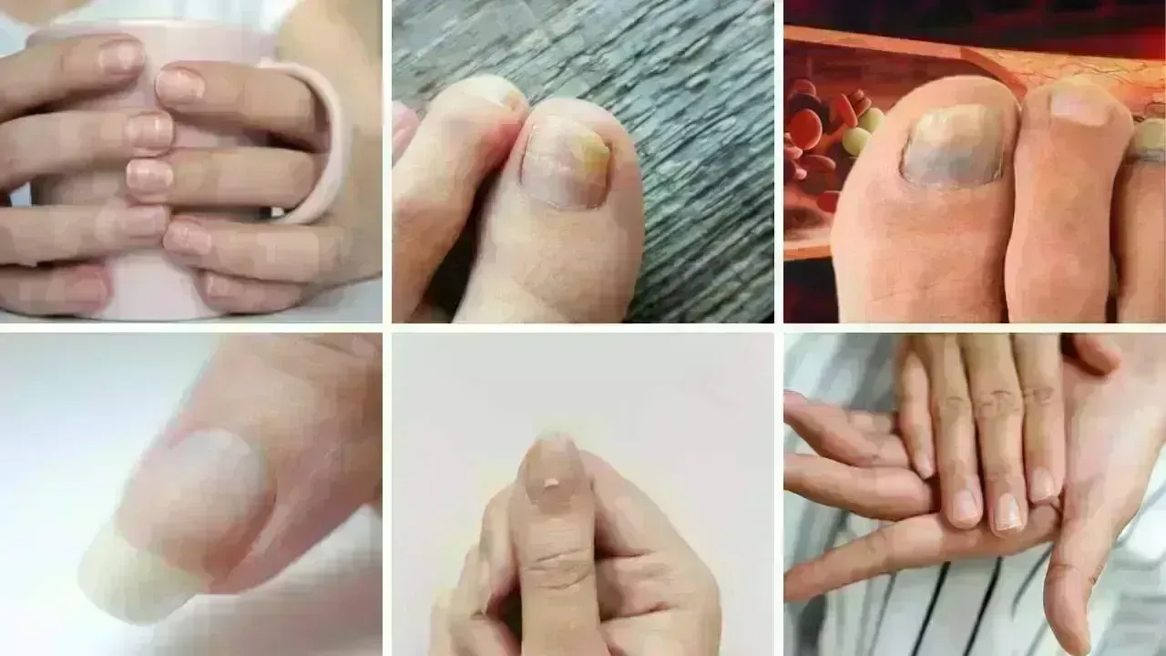 7 Nail Changes Indicating High Cholesterol You Can't Afford to Ignore