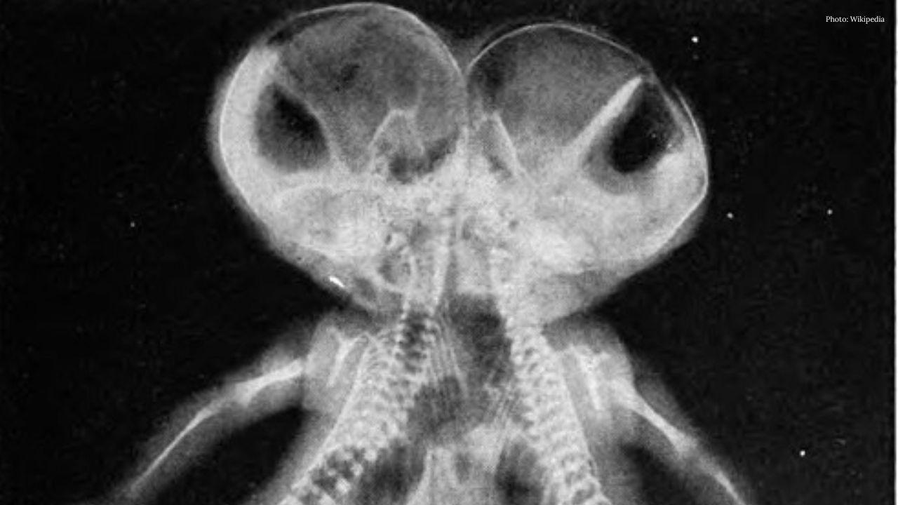 Pakistani Conjoined Twins Arrive in Saudi Arabia for Surgery Assessment