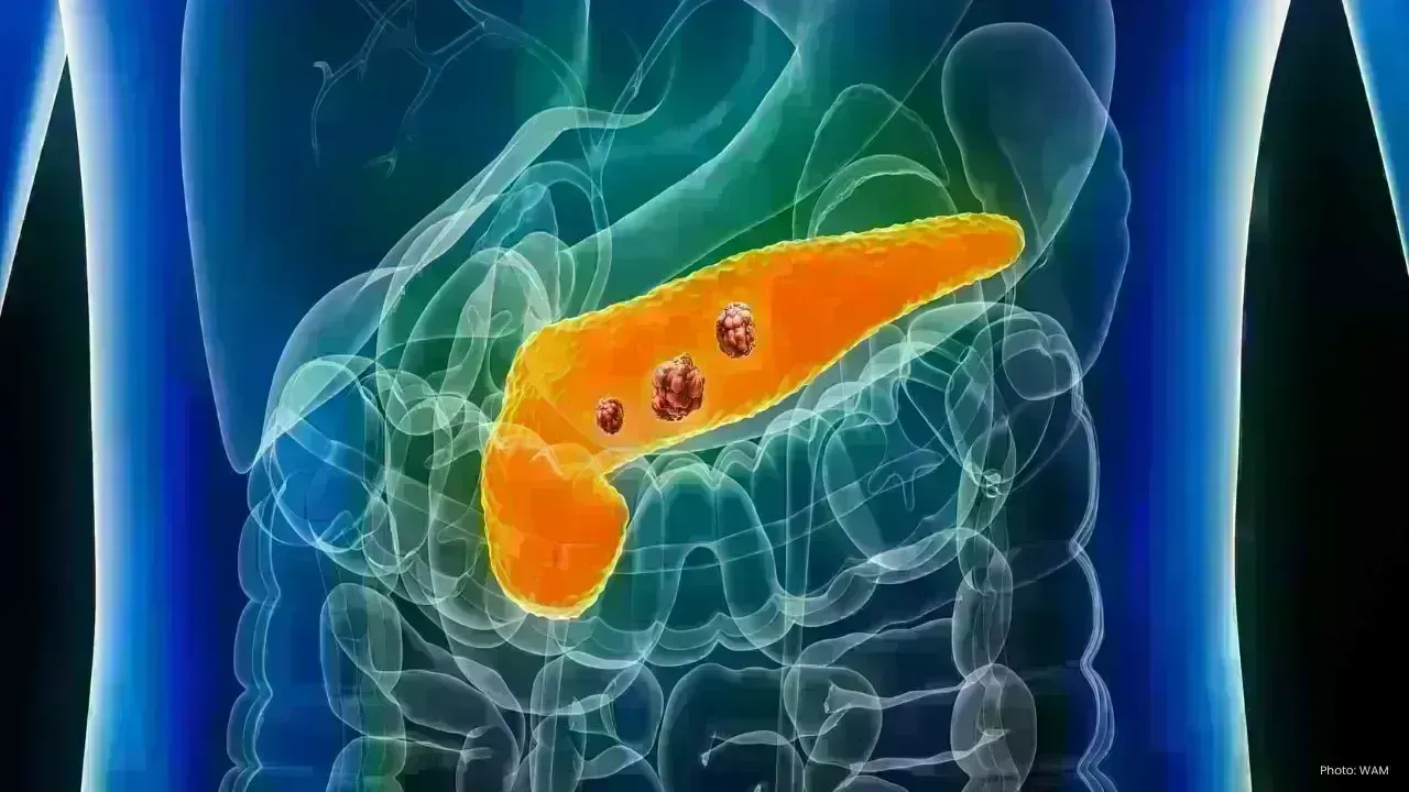 Revolutionary Oral Medication Offers New Hope in Pancreatic Cancer Treatment